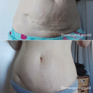 stretch marks and scars before and after dermapen microneedling
