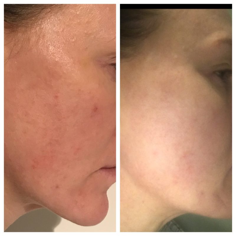 WOW fusion before and after toxing rosacea