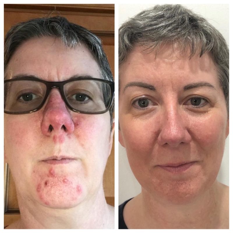 wow facial before and after