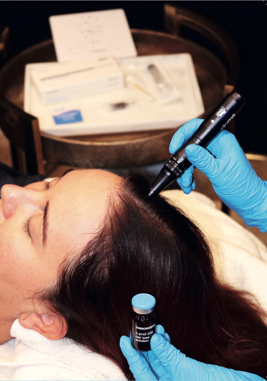 Mesotherapy for Hair Loss treatment in London