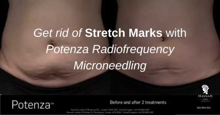 How to Remove Stretch Marks with Potenza Radiofrequency Microneedling Treatment?