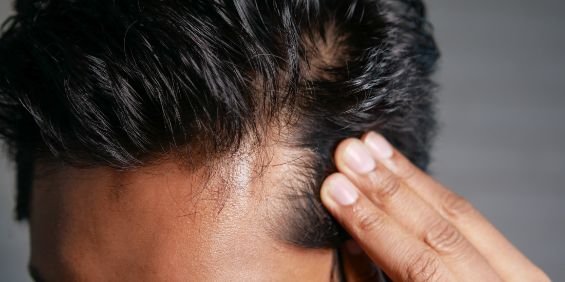 Exosomes therapy for hair loss